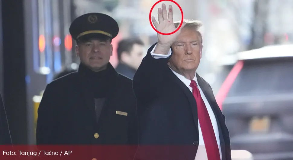 Spominjao se sifilis: Šta su crvene mrlje na Trampovoj ruci