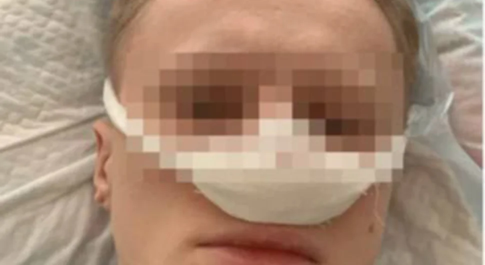 Млаз пива поломио нос конобару