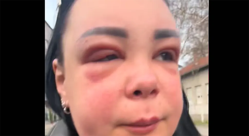 Alergijska reakcija na botoks skoro ugrozila život influenserke
